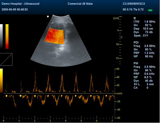 Eco doppler:(Imagen de doppler tisular) Analiza las velocidades en cualquier punto de la pared ventricular durante el ciclo cardiaco.